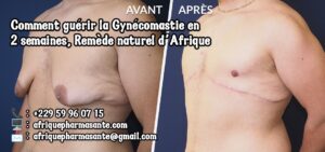 Découvrez le Remède Naturel pour la Gynécomastie : Guérison Définitive en 8 Semaines