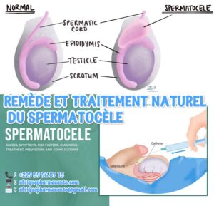 Comment Guérir le Spermatocele Naturellement Traitement naturel du spermatocèle