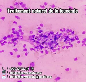 Traitement Naturel du Lupus : Une Solution Efficace et Définitive