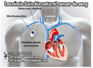 Voilà le Traitement de la leucémie remède bio pour soigner le Cancer du Sang