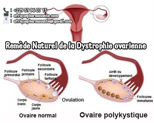 Comment Traiter la Dystrophie Ovarienne? Traitement naturel 15 jours Dystrophie Guérison Définitive