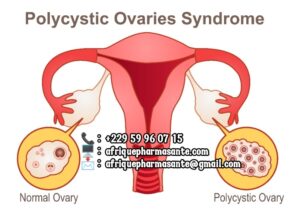 Comment Soigner la Dystrophie Ovarienne en 15 jours Guérison Définitive de la Dystrophie Ovarienne