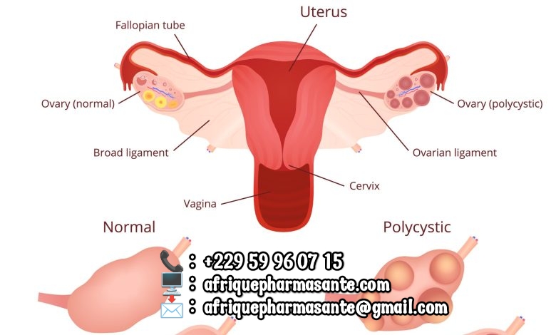 Comment Soigner la Dystrophie Ovarienne en 15 jours Guérison Définitive de la Dystrophie Ovarienne