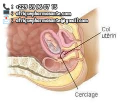 Cerclage Africain pour garder la grossesse