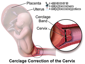 Comment faire le Cerclage à l'Africain? : Traitement Naturel de cerclage de grossesse