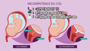 Traitez la Mycose Vaginale Naturellement : Guérison Définitive en 8 Semaines avec Afrique Pharma Santé