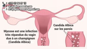 Traitement Naturel de la Mycose Vaginale : Guérison Définitive en 8 Semaines avec Afrique Pharma Santé