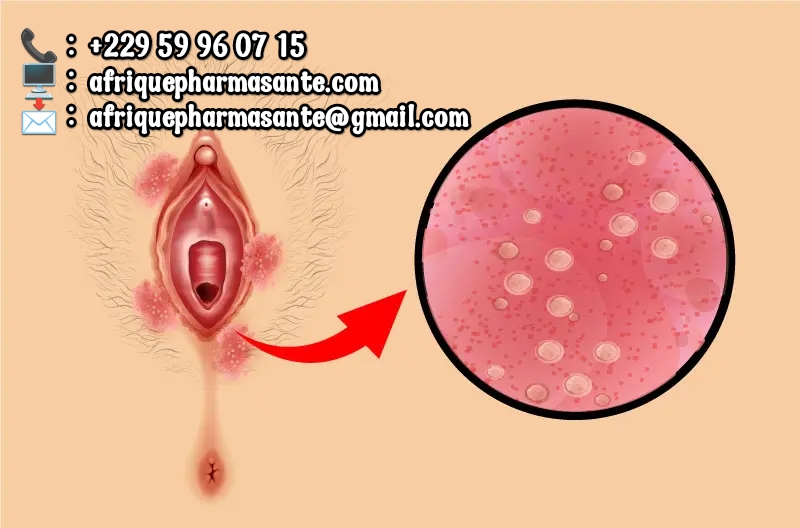 Comment soigner Les infections vaginales?