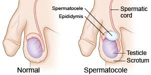 Traiter et Guérir le Spermatocele Naturellement : Votre Solution Disponible sur Afrique Pharma Santé