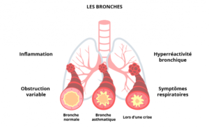 Astuces de grand-mère pour soigner l'asthme