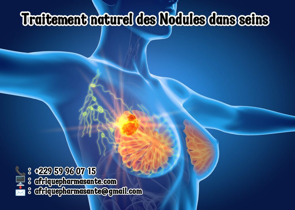 Nodules Mammaires : Optez pour un Traitement Naturel Efficace