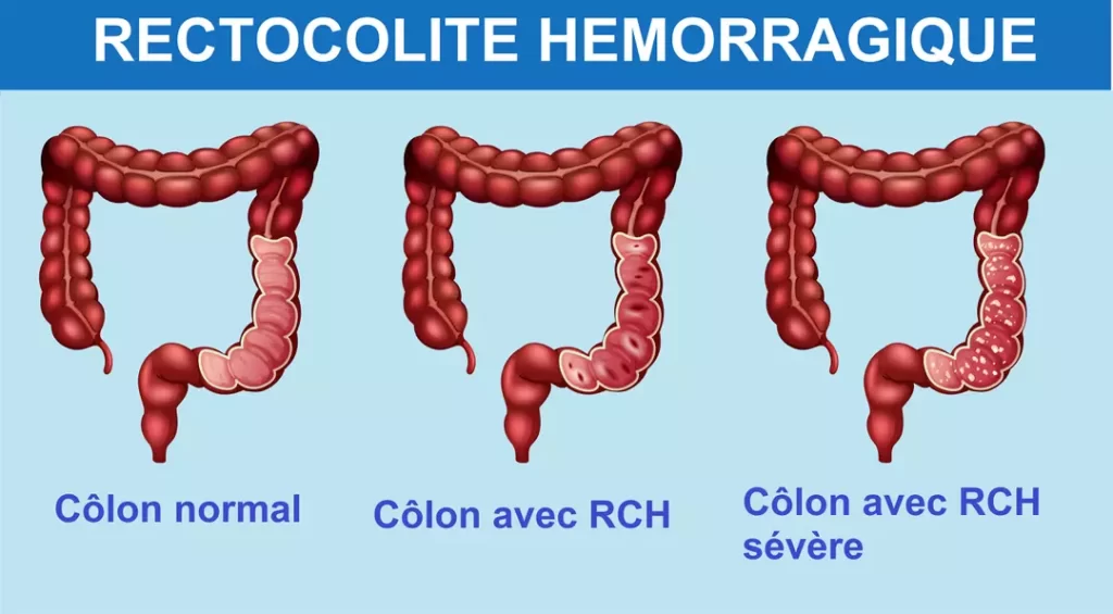 Comment soigner la Rectorragie Traitement Naturel de la Rectorragie