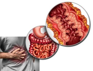 Comment soigner la Maladie de Crohn Traitement Naturel de la Maladie de Crohn Soin bio