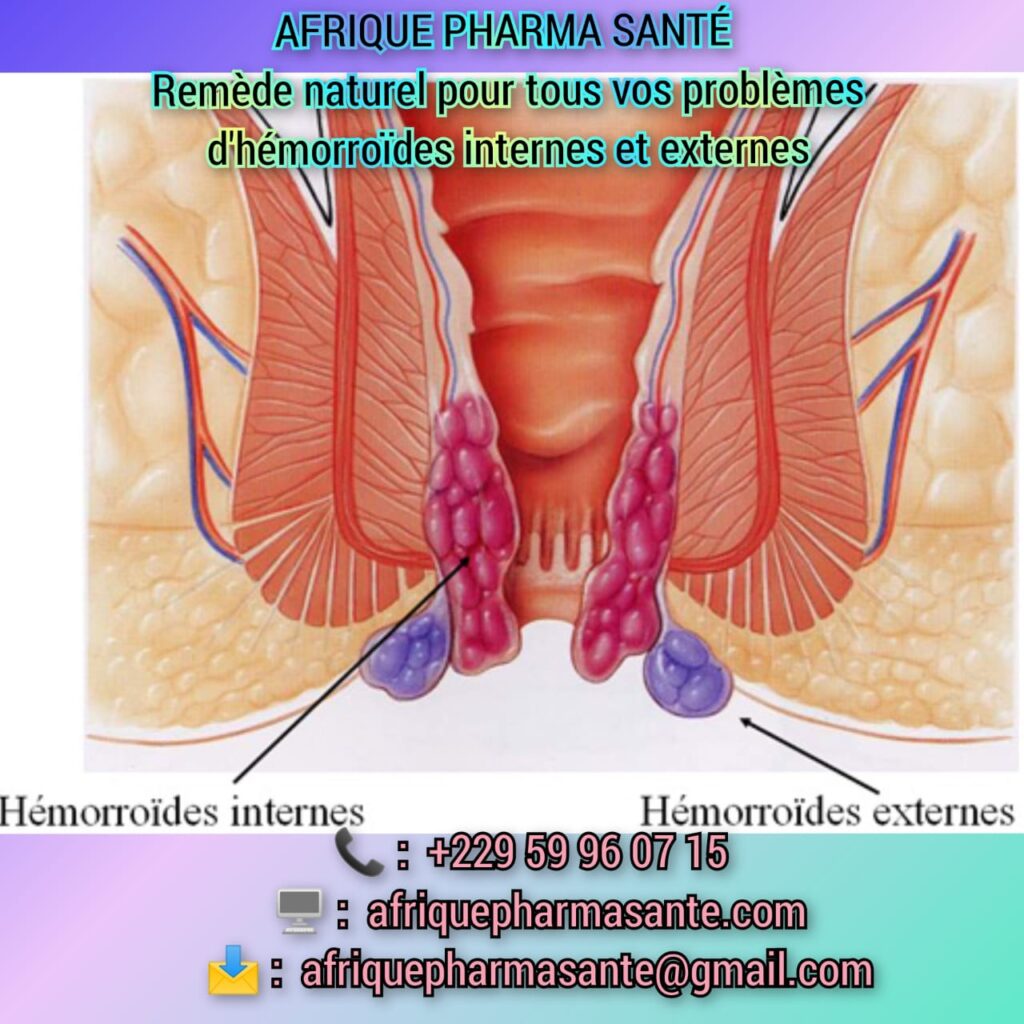 Traitement Naturel et Bio d’Afrique Contre les Hémorroïdes Internes et Externes