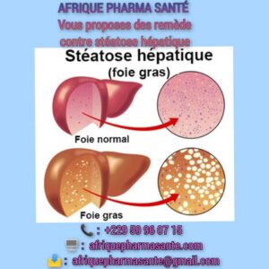 Comment soignet la Stéatose Hépatique : Un Enjeu de Santé à Ne Pas Négliger