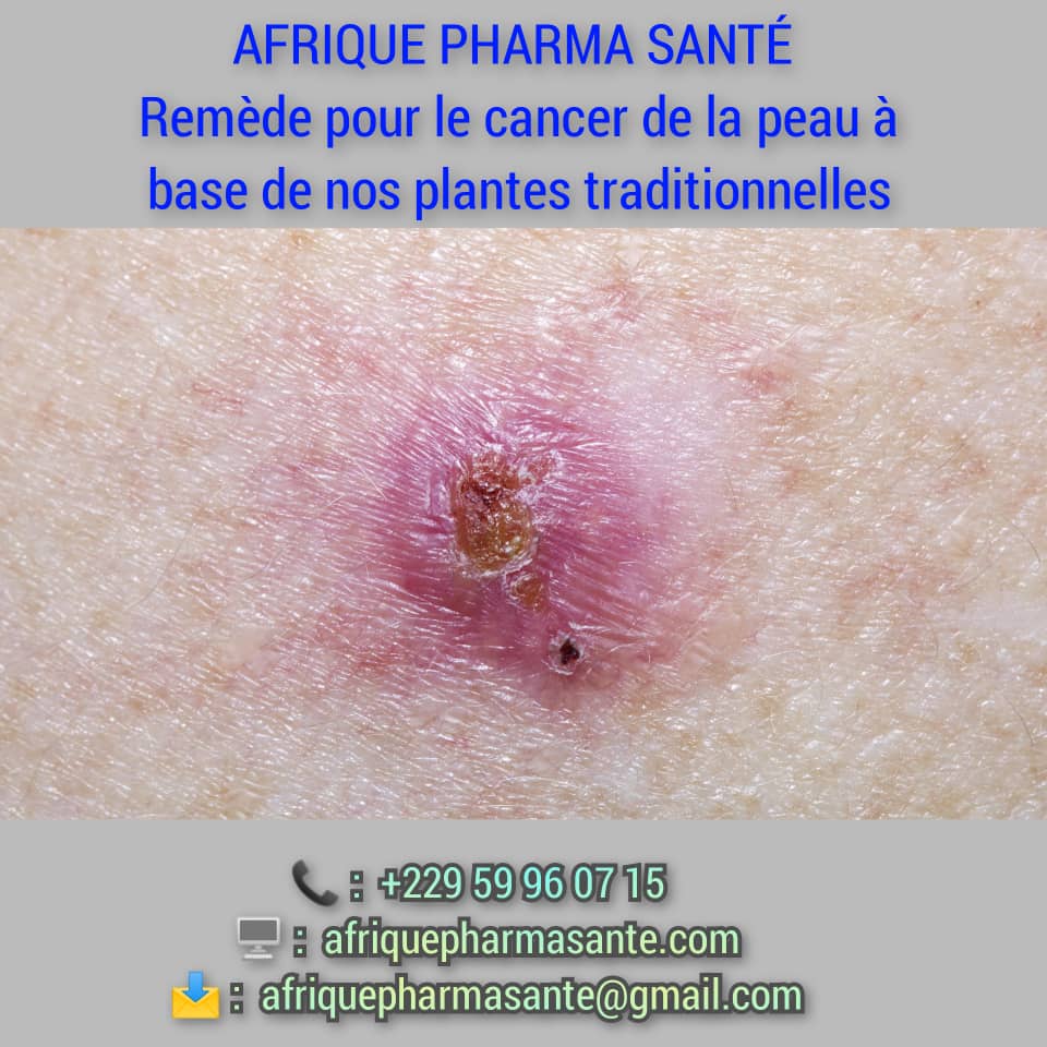 Traitement Naturel et Définitif du Cancer de Peau : Une Solution Bio et Traditionnelle par Afrique Pharma Santé