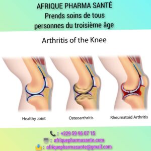 Blog sur l'Arthrite Maladie des os personnes de 3eme age : Découvrez un Traitement Naturel pour une Guérison Définitive