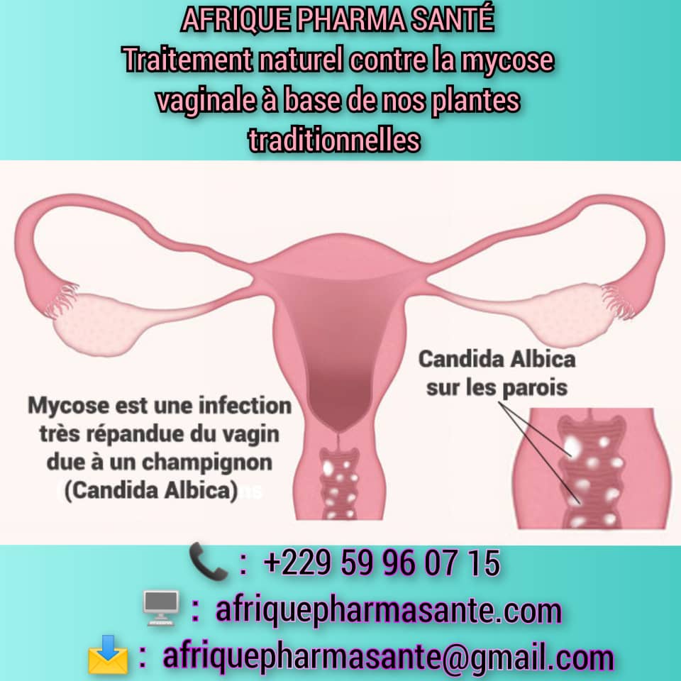 Mycose Vaginale et Comment s’en Débarrasser Définitivement, Tout Savoir sur la Mycose Vaginale