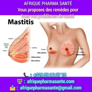 Comment soigner la Mastitis Traitement Naturel de la Mastitis : Votre Solution Disponible sur Afrique Pharma Santé