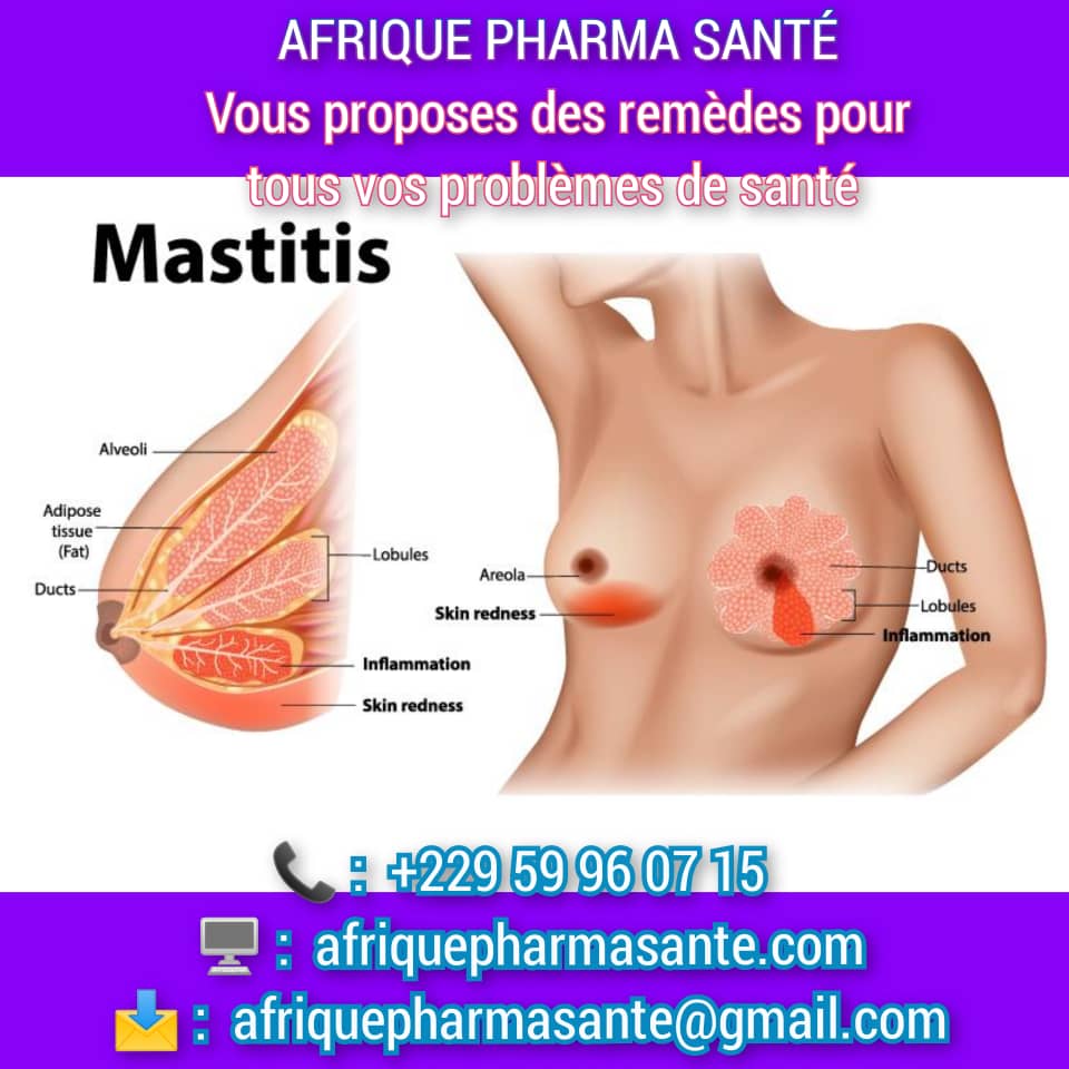 Comment soigner la Mastitis Traitement Naturel de la Mastitis : Votre Solution Disponible sur Afrique Pharma Santé