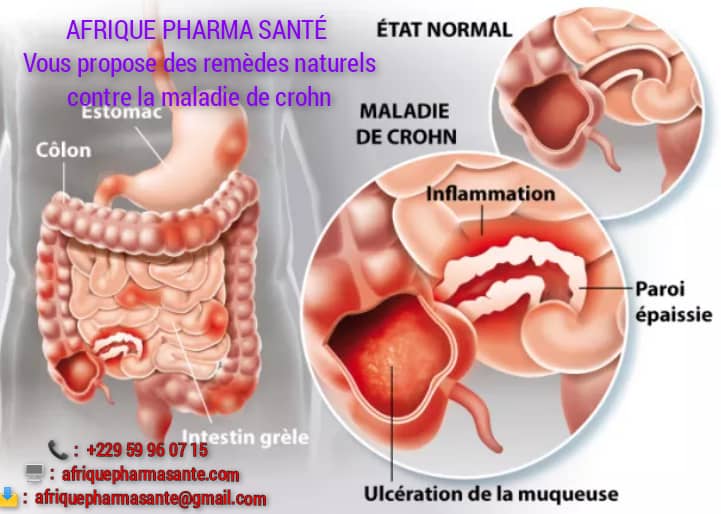 Maladie de Crohn : Un Traitement Naturel pour Retrouver Votre Confort Digestif