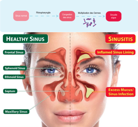 Voilà comment se débarasser de la sinusite Traitement naturel