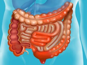 Comment soigner la Maladie de Crohn Traitement Naturel de la Maladie de Crohn Soin bio