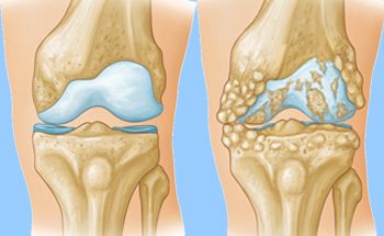 Zoome sur Arthrite du Genou : Un Remède Naturel pour Une Guérison Définitive