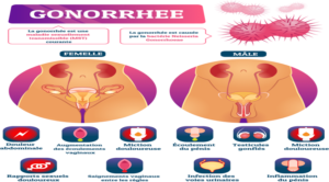 COMMENT LA GONOCOCCIE THERAPIE NATURELLE DE L'INFECTION SEXUELLEMENT TRANSMISSIBLE 