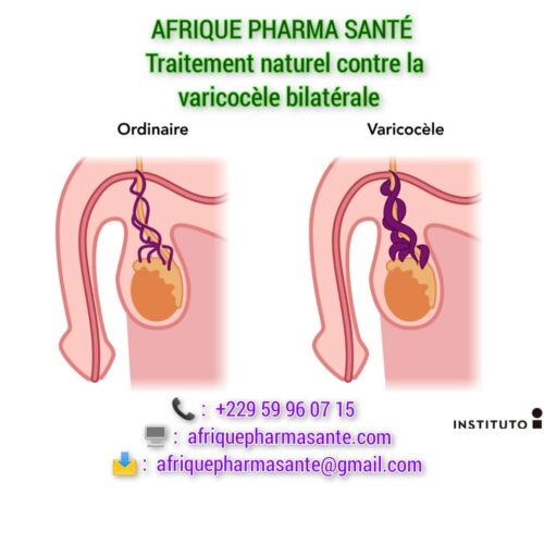 Remède 322 : Traitement Naturel de la Varicocèle Thérapie naturelle: Soulagement et Guérison Par les Plantes