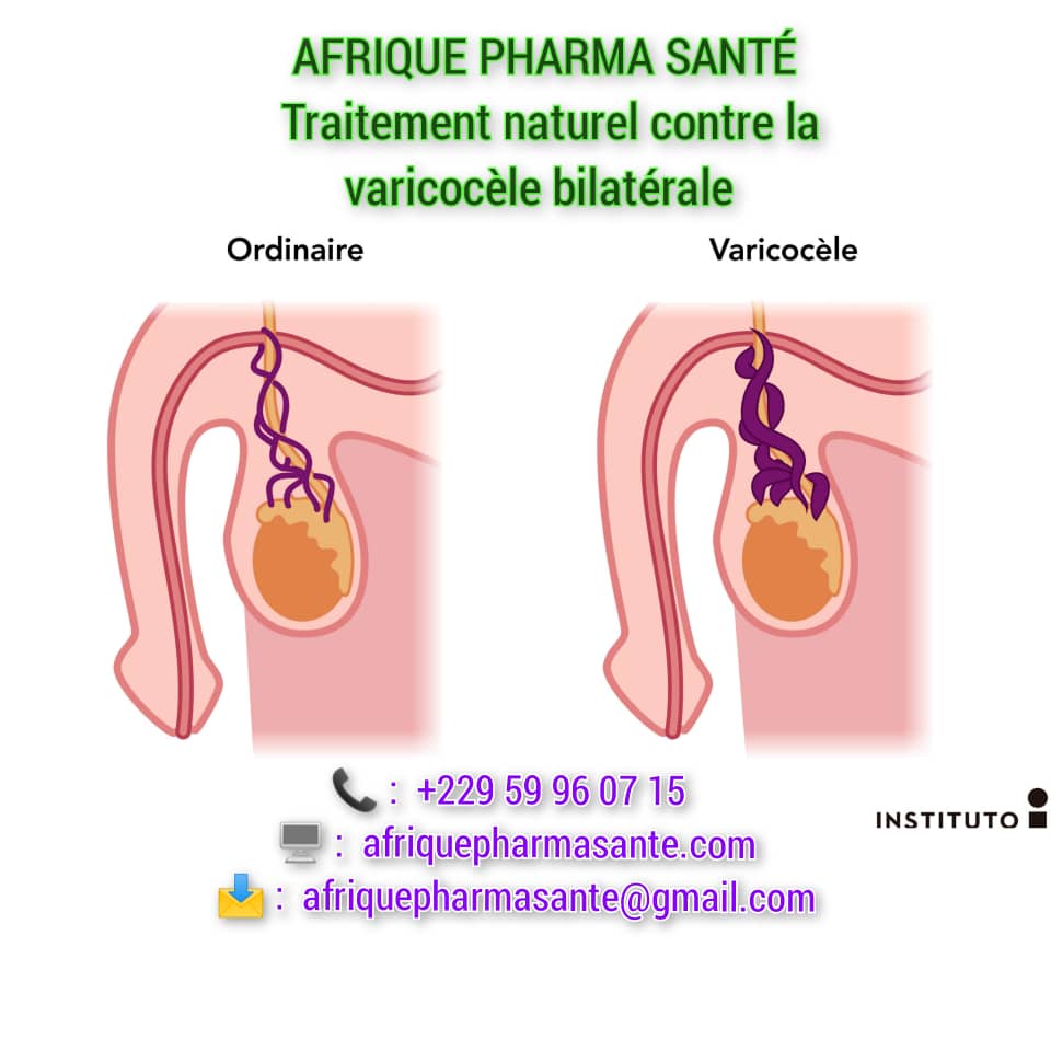 Traitement naturel pour varicocèle bilatérale : Causes Symptômes et Remède naturel