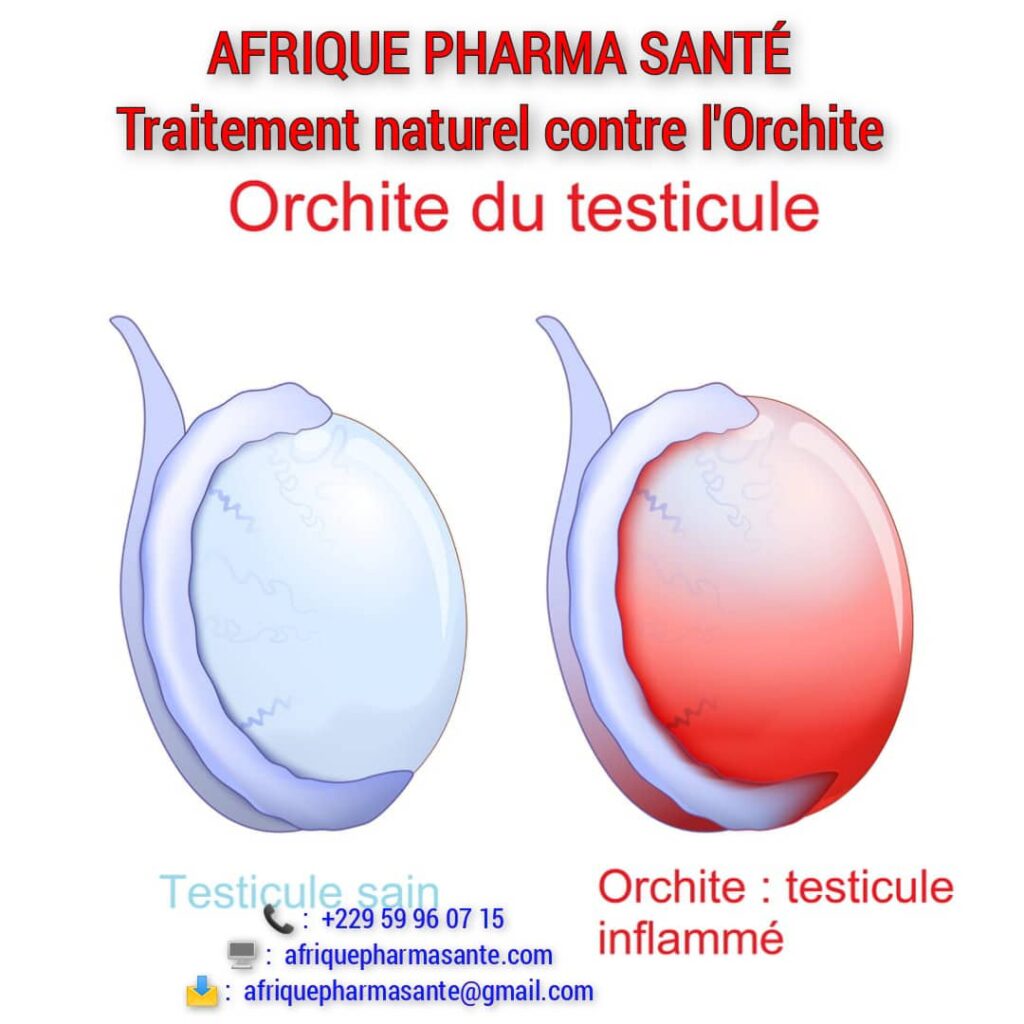 Remède naturel Orchite Testiculaire : Causes, Symptômes et Traitement Naturel