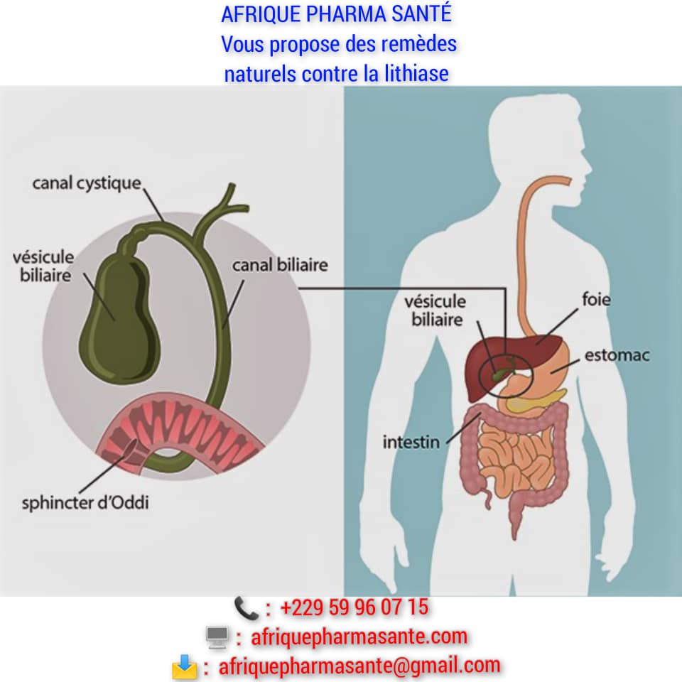 Traitement naturel lithiase : Causes Symptômes et Traitement Naturel