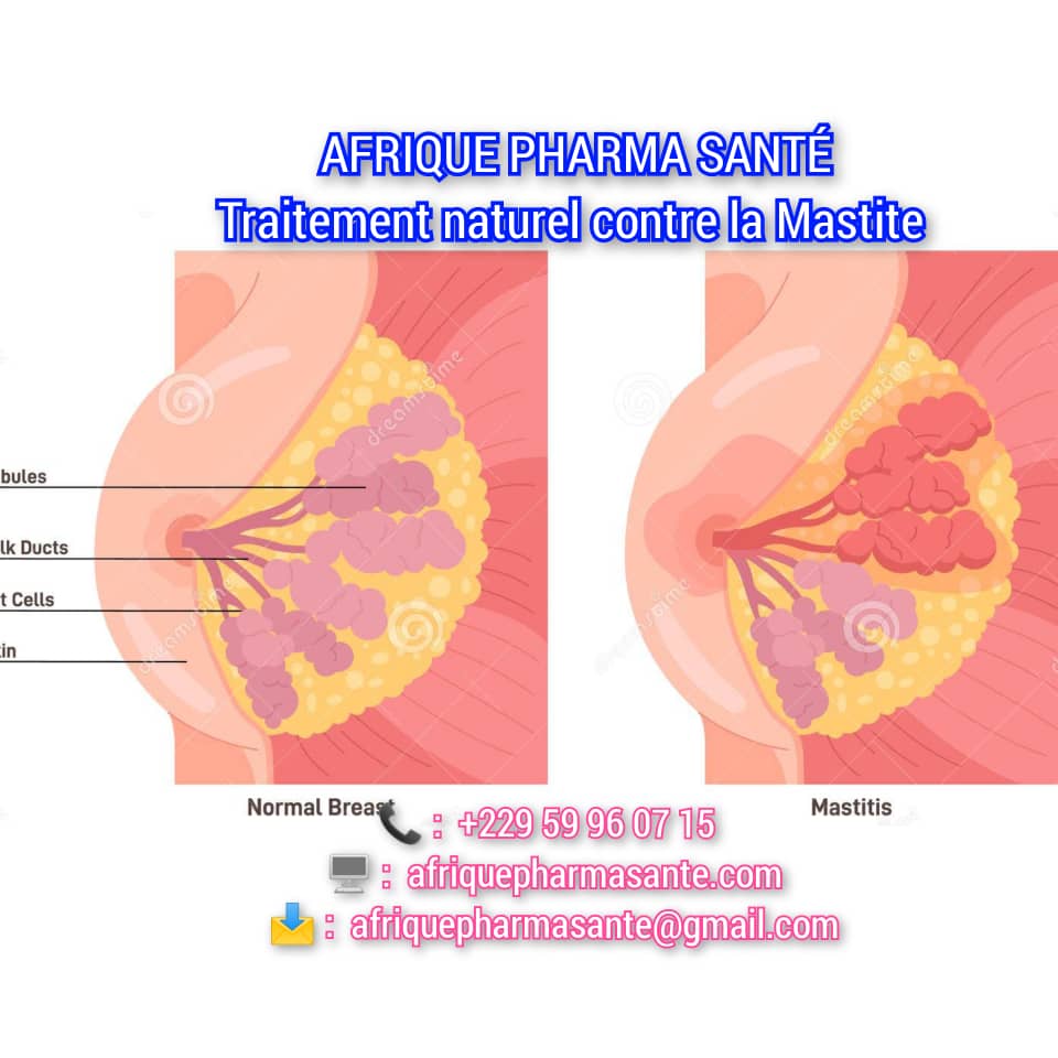 Comment soigner la Mastite : Causes, Symptômes et Traitement Naturel Disponible chez Afrique Pharma Santé