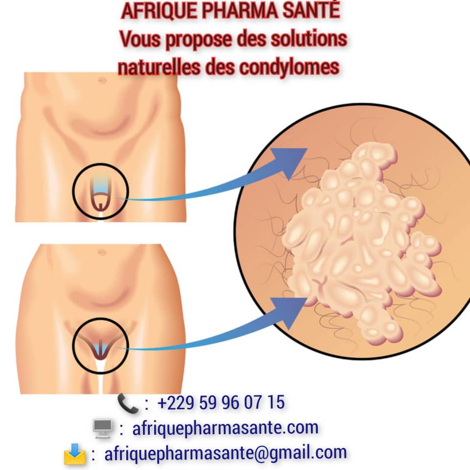 Comment soigner les Condylomes : Causes, Symptômes et Traitement Naturel avec Afrique Pharma Santé