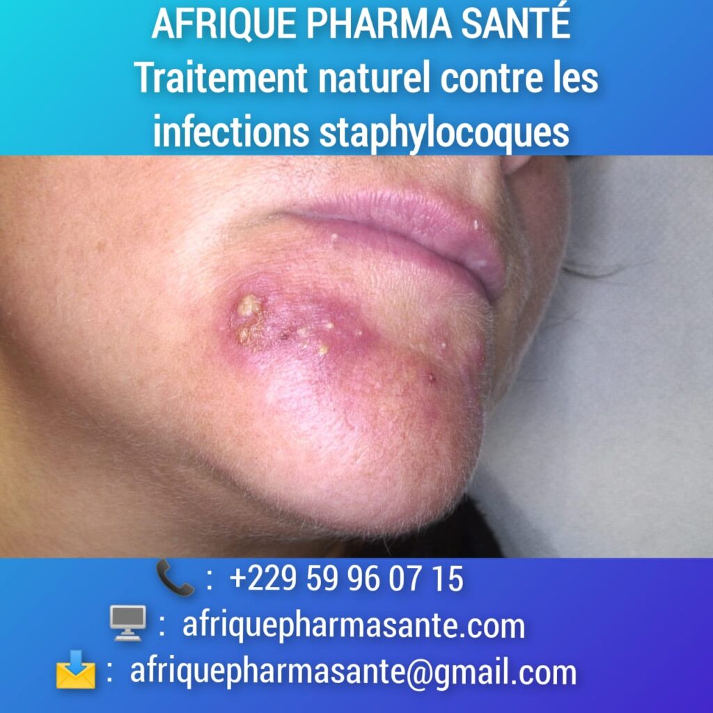 Comment soigner Staphylocoque naturellement : Causes, Symptômes et Traitements Naturels Disponibles chez Afrique Pharma Santé