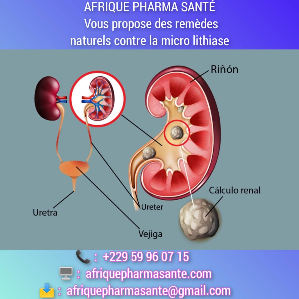 Micro-lithiase et Polypes du Côlon soin bio naturel : Identification des Causes, Symptômes et Traitement Naturel - Afrique Pharma Santé