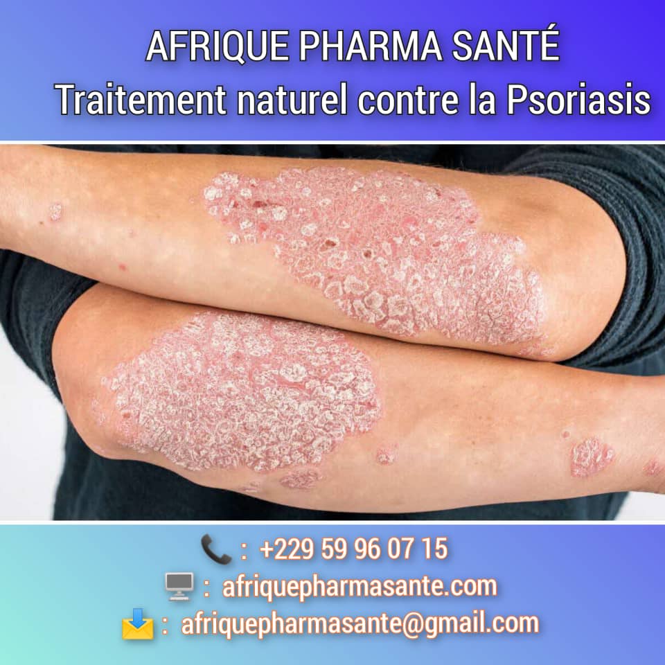 Comment soigner Psoriasis naturellement : Causes, Symptômes, et Traitements Naturels Disponibles chez Afrique Pharma Santé