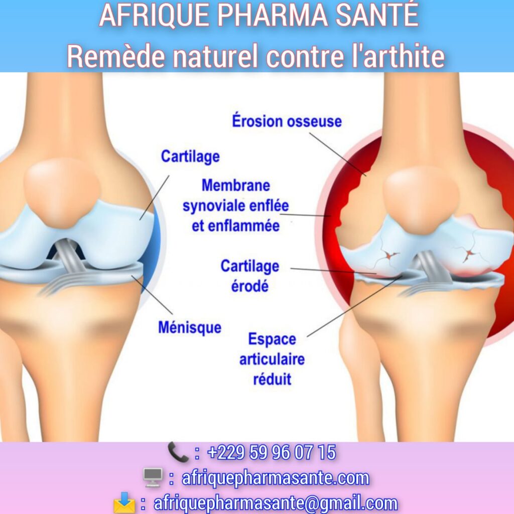 Voilà comment guérir Arthrite naturellement : Causes, Symptômes et Traitement Naturel Disponible chez Afrique Pharma Santé