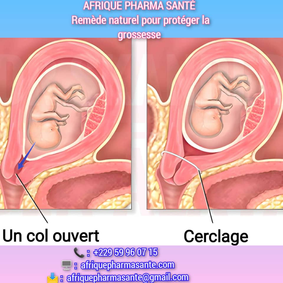 Comment Protéger la Grossesse : Causes, Symptômes et Traitements Naturels Disponibles sur Afrique Pharma Santé