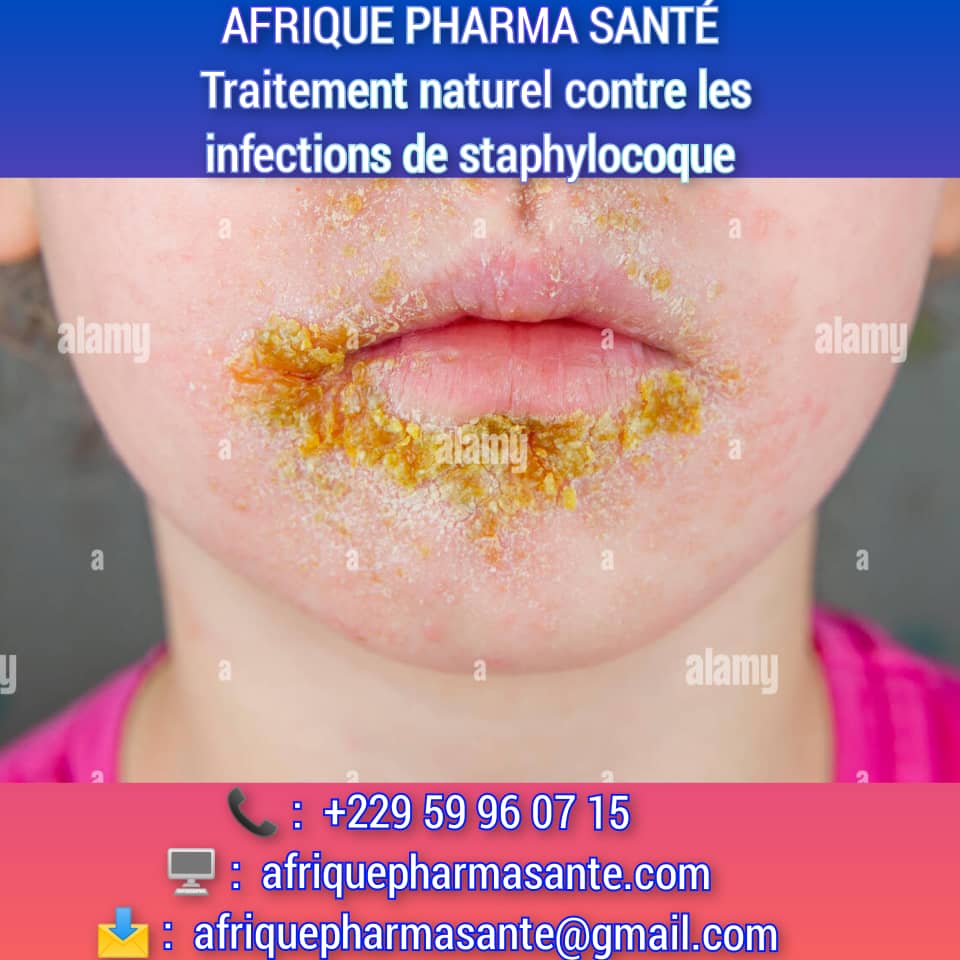 Comment soigner Staphylocoque naturellement : Causes, Symptômes, et Traitement Naturel avec AFRIQUE PHARMA SANTÉ