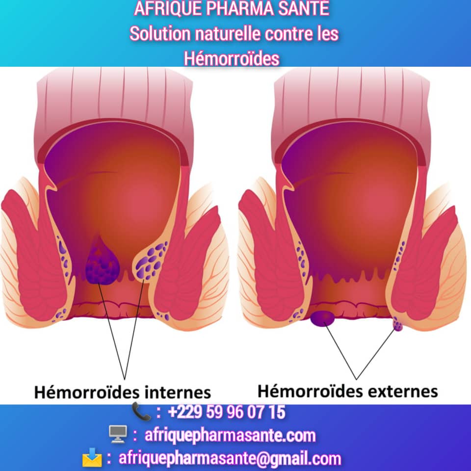 Meilleur Remède Naturel Contre les Hémorroïdes : Traitement Efficace Disponible sur Afrique Pharma Santé