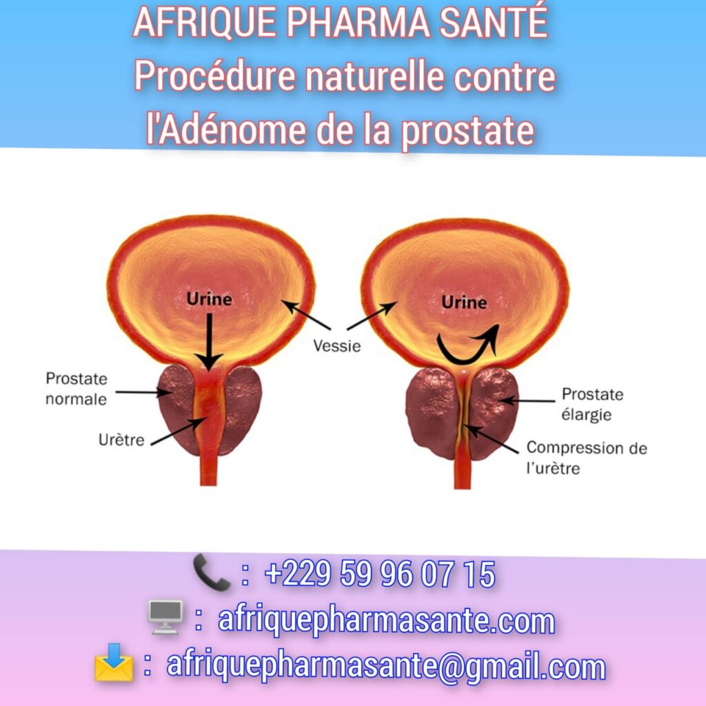 Meilleur Traitement Naturel Contre l’Adénome de la Prostate - Afrique Pharma Santé