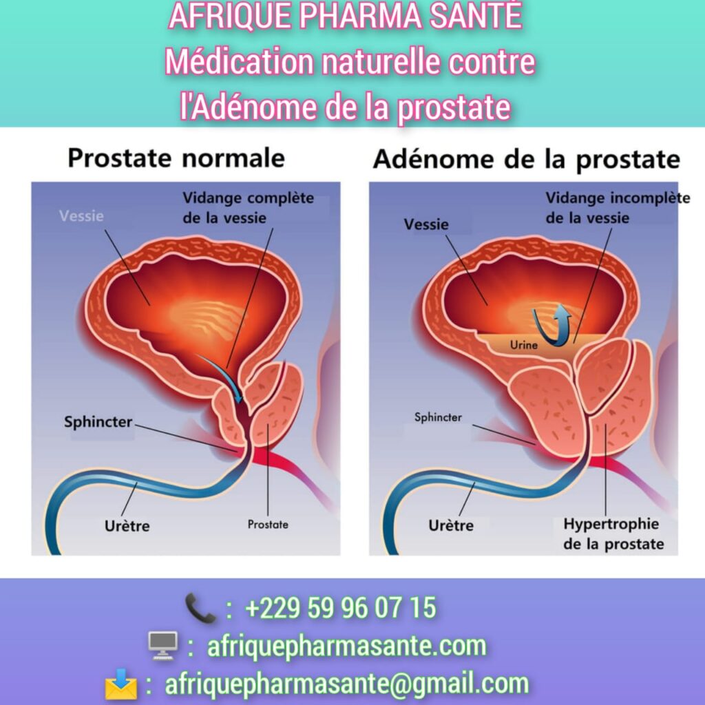 Remède Bio pour Soigner l’Adénome de la Prostate: Un Traitement Naturel et Efficace Disponible chez Afrique Pharma Santé