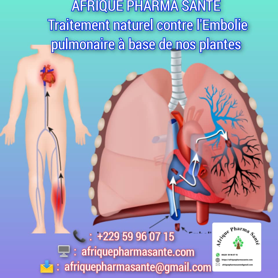 Meilleur soin de l'Embolie Pulmonaire : Identification des Causes, Symptômes et Traitement Naturel avec Afrique Pharma Santé