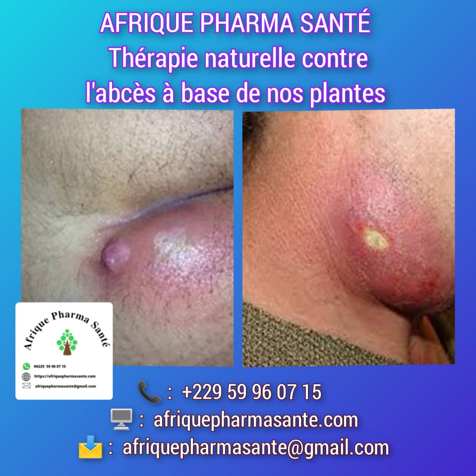 Soin bio Contre les abcès : Traitement Naturel et Soins Bio Disponible chez Afrique Pharma Santé