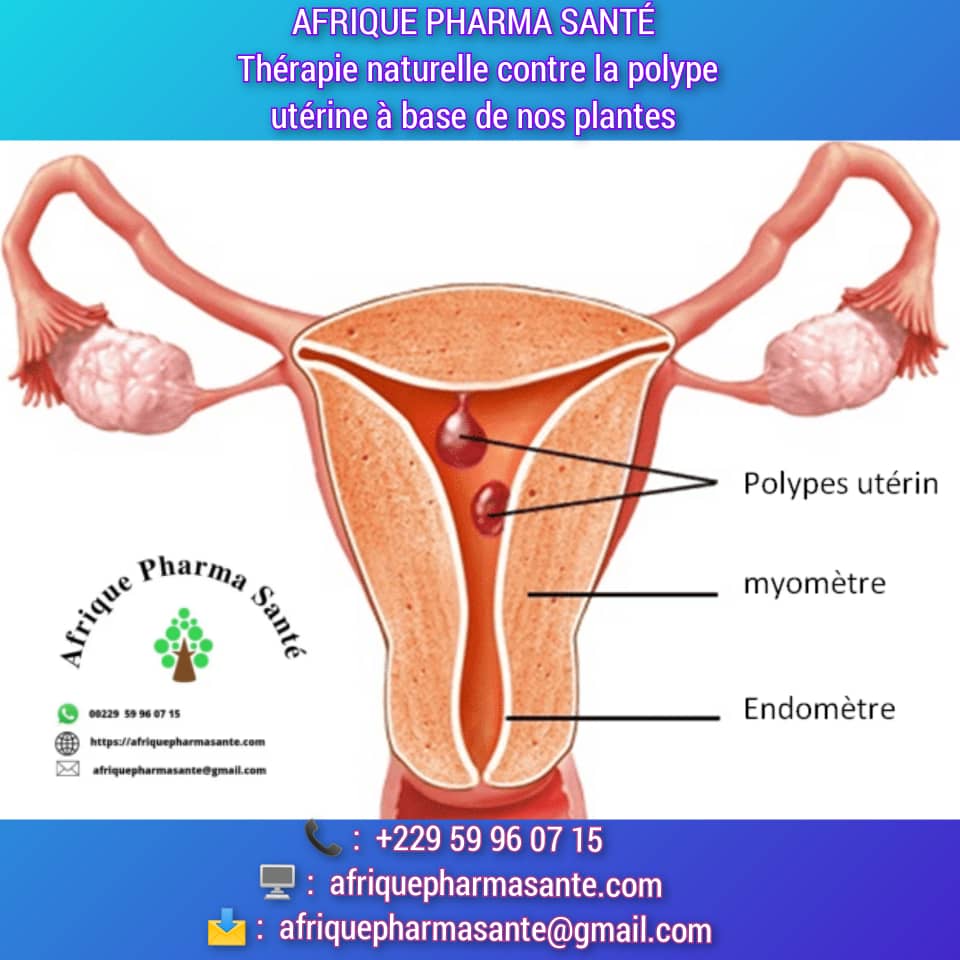 Traitement naturel Polypes utérins : Causes, Symptômes et Traitement Naturel Disponible chez Afrique Pharma Santé