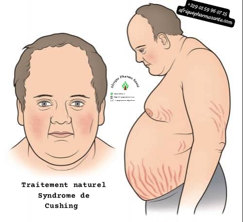 Traitement naturel Syndrome de Cushing (forme rare) : Un soin naturel pour améliorer la qualité de vie