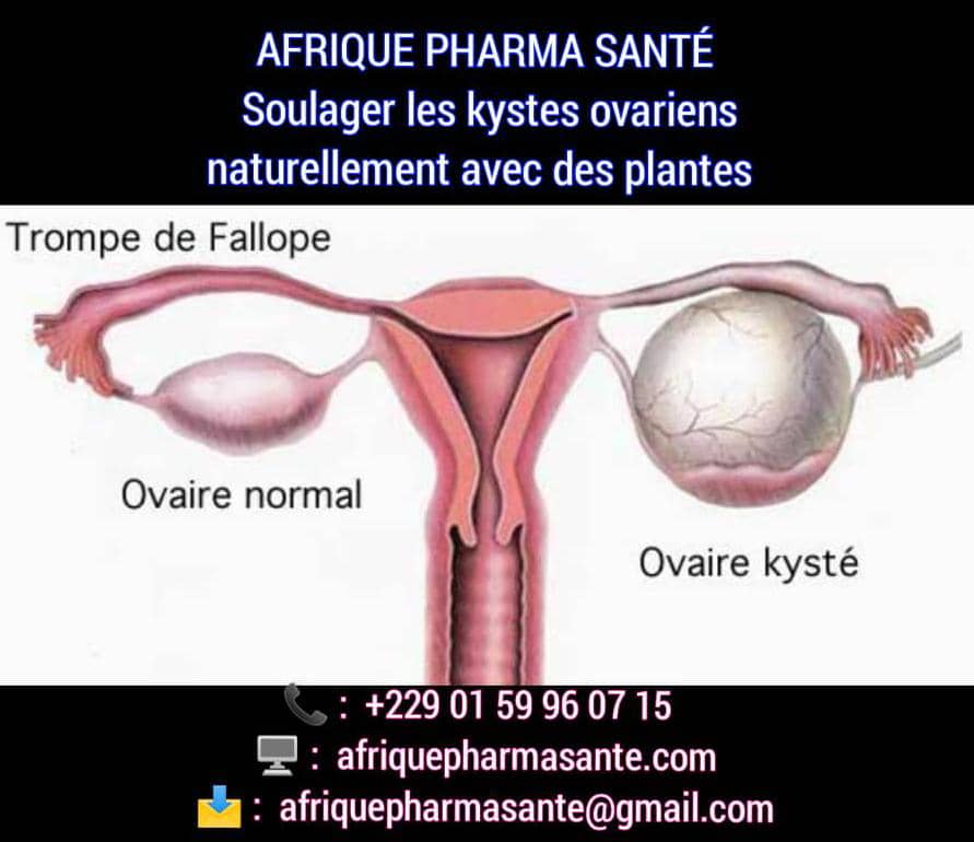 Traitement Naturel des Kystes Ovariens : Remède Bio Efficace Sans Chirurgie