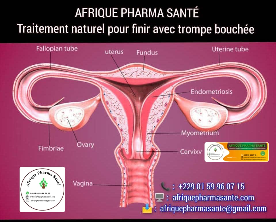 Trompes Bouchées et Infertilité Féminine : Traitement Naturel Efficace à Base de Plantes